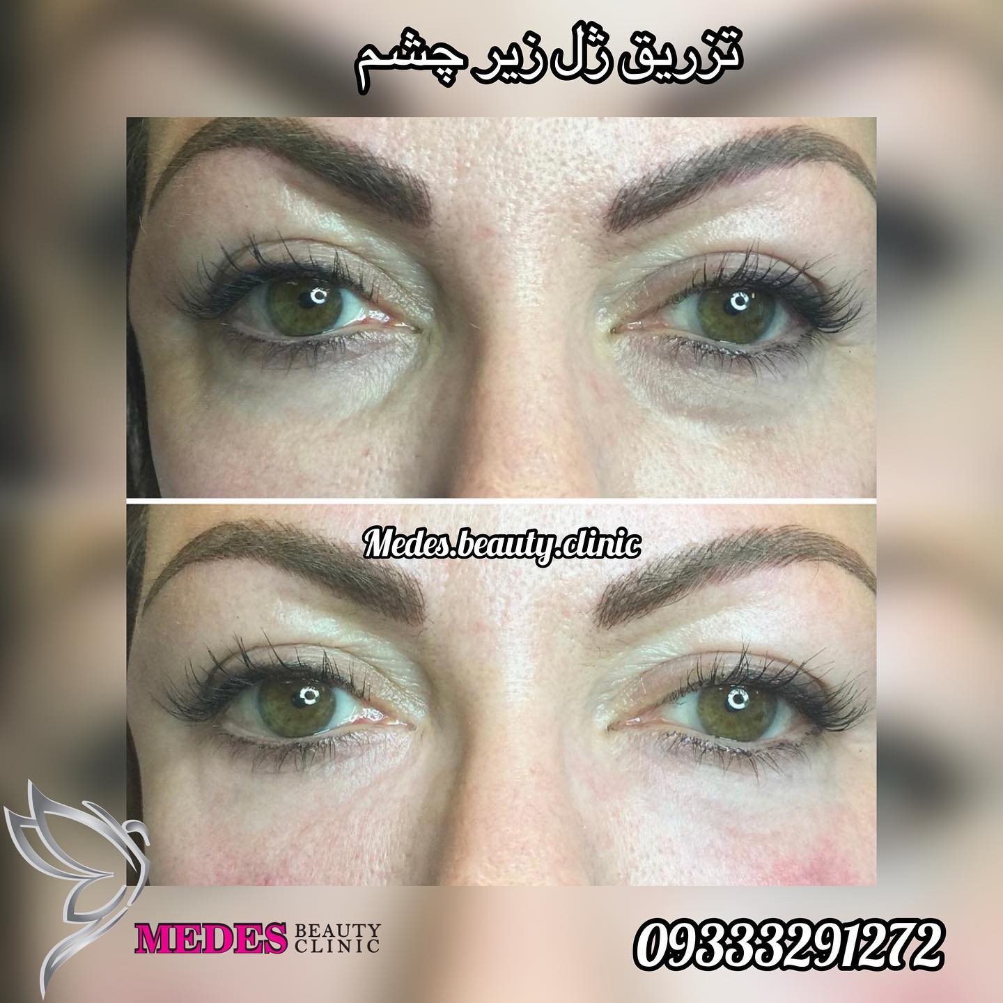 گالری فیلر زیر چشم